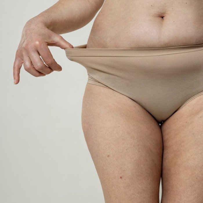 lipedema.jpg